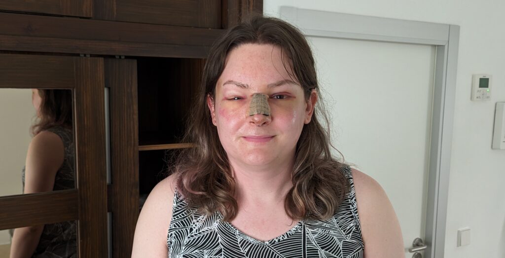 A photograph of Chris Northwood showing a swollen and bruised face, with a brace over her nose.